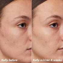 Kelly's Skin Before and After Using Clarifying Facial Oil for 4 Weeks