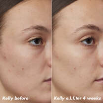 Kelly's Skin Before and After Using Clarifying Facial Oil for 4 Weeks