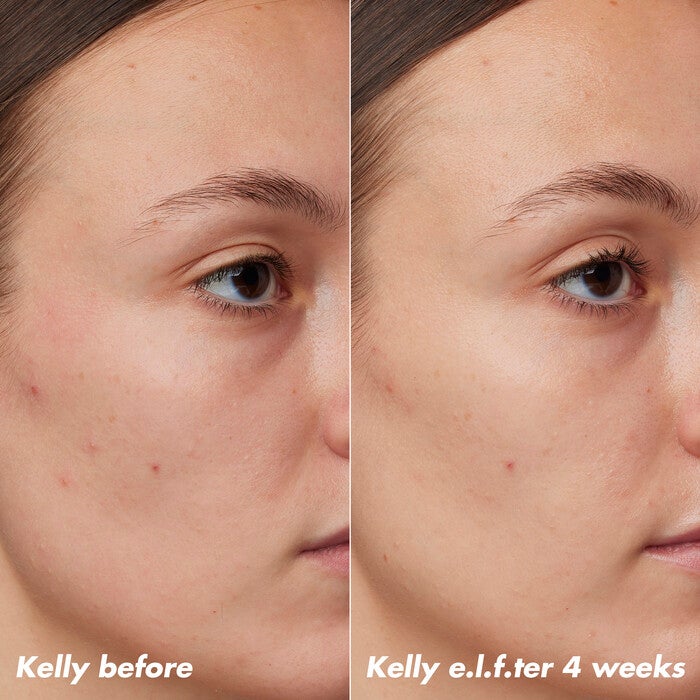 Kelly's Skin Before and After Using Clarifying Facial Oil for 4 Weeks