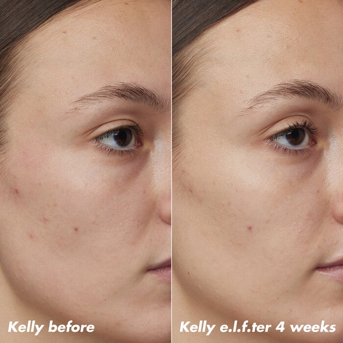 Kelly's Skin Before and After Using Clarifying Facial Oil for 4 Weeks