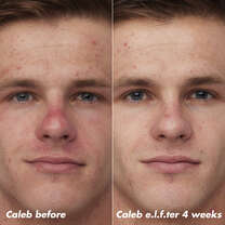 Caleb Before and After Using Clarifying Facial Oil for 4 Weeks