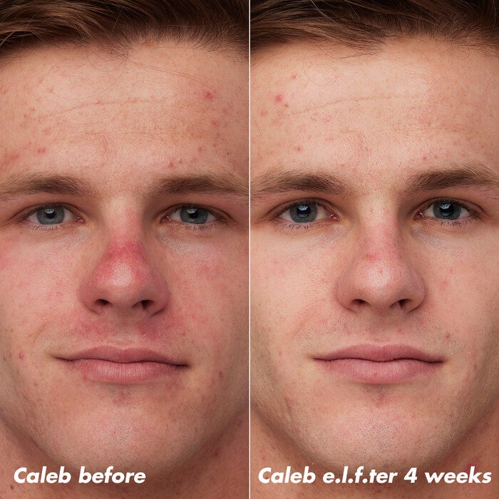 Caleb Before and After Using Clarifying Facial Oil for 4 Weeks