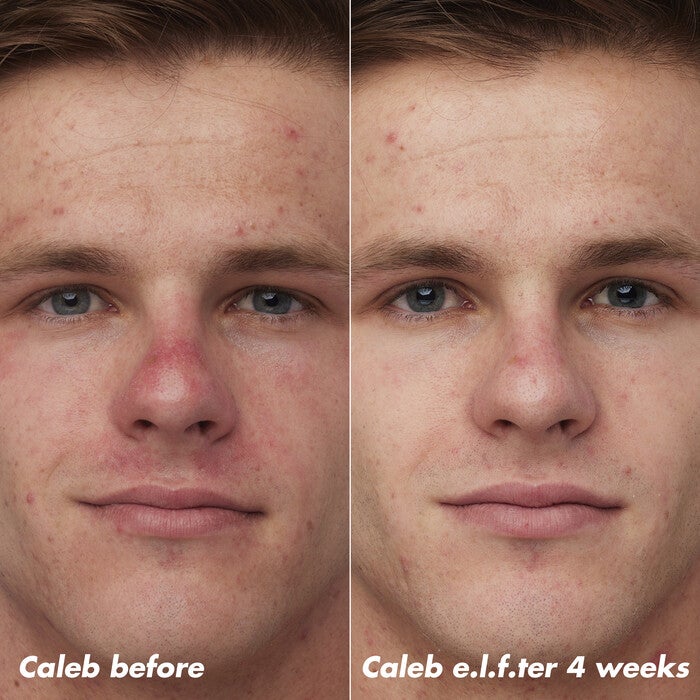 Caleb Before and After Using Clarifying Facial Oil for 4 Weeks