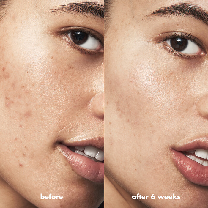 Before and After Using Blemish Breakthrough Serum Results