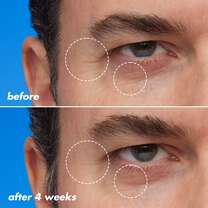 Fine Line and Wrinkles Before and After Using Retinoid Face Oil for Four Weeks