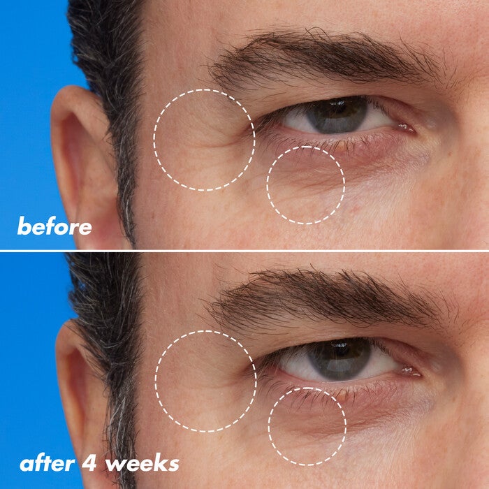 Fine Line and Wrinkles Before and After Using Retinoid Face Oil for Four Weeks