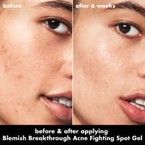 Before and After Use of Acne Spot Gel
