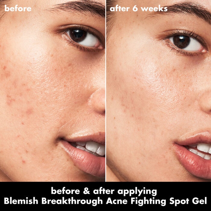 Before and After Use of Acne Spot Gel