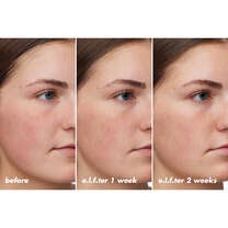 Before and After Using Barrier Goal Cream for Two Weeks