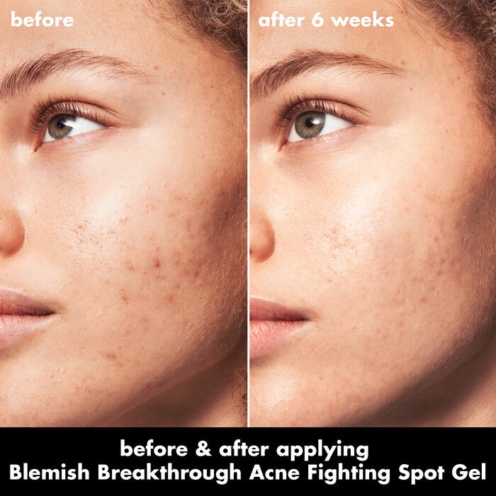 Before and After Acne Gel