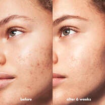 Before and After Using e.l.f. Acne Skincare Routine Products