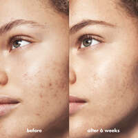 Blemish Breakthrough Acne Calming Water Cream, 
