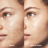 Before and After Acne Gel