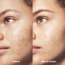 Before and After Using Blemish Fighting Spot Gel
