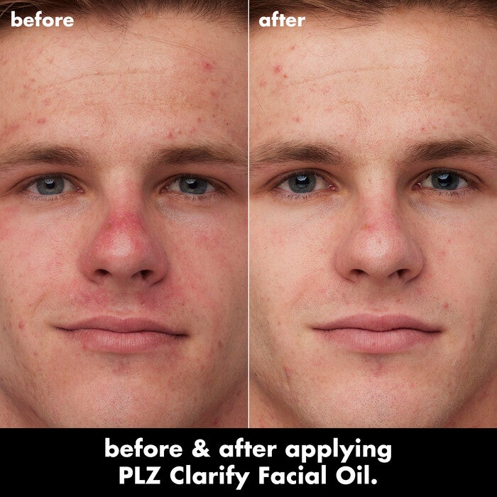 Caleb Before and After Using Clarifying Facial Oil for 4 Weeks