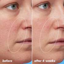 Before and After Using Retinoid Night Oil for Four Weeks