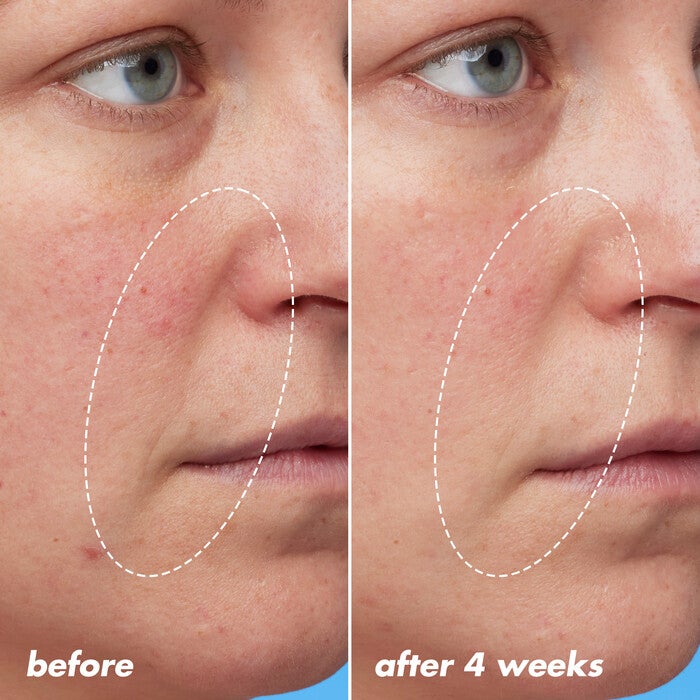 Before and After Using Retinoid Night Oil for Four Weeks