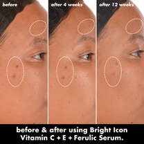 Before and After Results After Using Vitamin C +E + Ferulic Brightening Face Serum