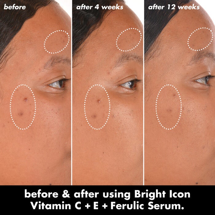 Before and After Results After Using Vitamin C +E + Ferulic Brightening Face Serum