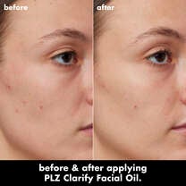 Kelly's Skin Before and After Using Clarifying Facial Oil for 4 Weeks