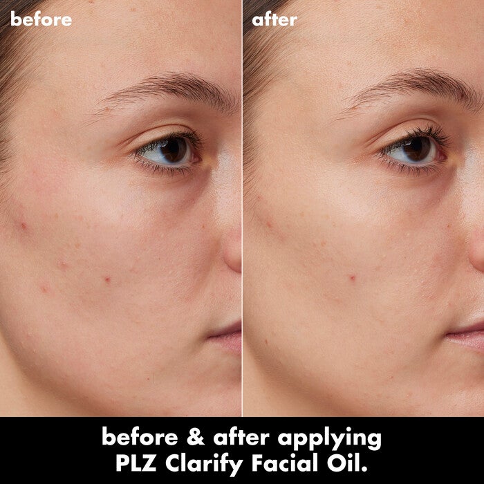 Kelly's Skin Before and After Using Clarifying Facial Oil for 4 Weeks